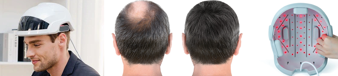 Hairgroei & roodlicht therapie